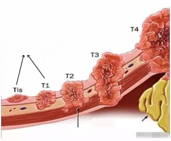 Ngày càng có nhiều bệnh ung thư ở nông thôn, có phải do ô nhiễm?