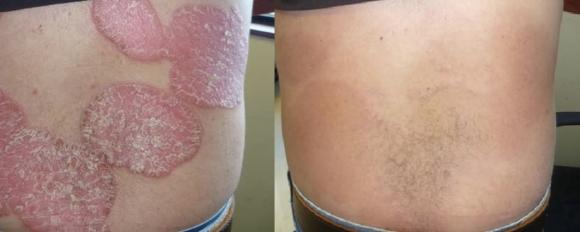 benh-vay-nen-1347-1-ngoisaovn-w919-h369 1 viêm da mãn tính, vảy nến, chữa bệnh vảy nến, Thảo dược Dr Michaels