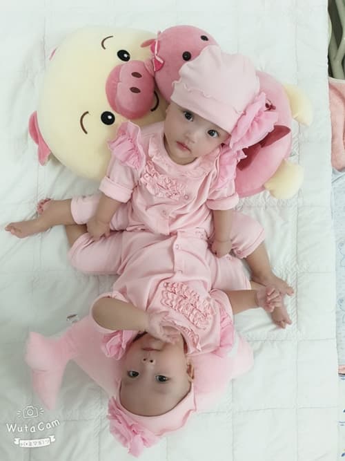 phẫu thuật cặp song sinh dính liền nhau, cặp song sinh dính liền thân, cặp song sinh dính liền