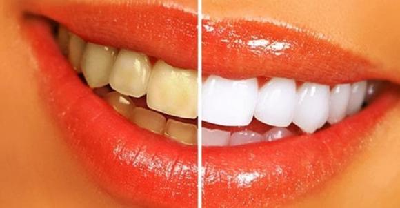 làm trắng răng, lưu ý khi làm trắng răng, Làm trắng răng có gây hại cho răng của bạn không