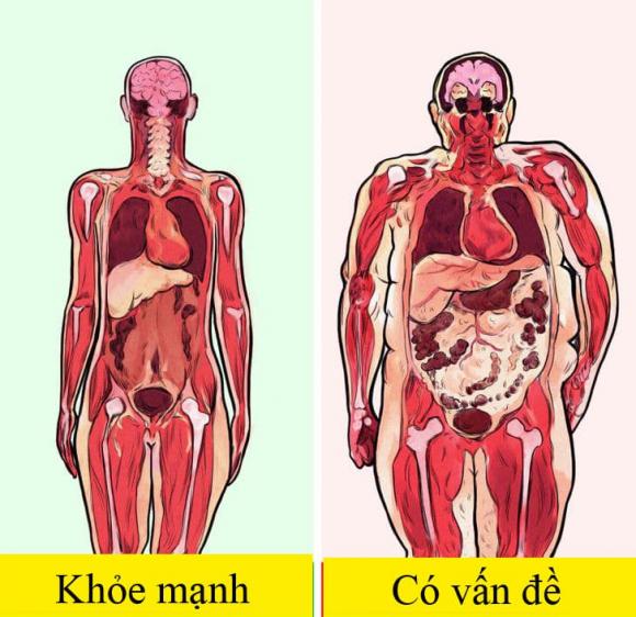 mỡ bụng, mỡ bụng hay có bệnh gì, dấu hiệu mắc bệnh