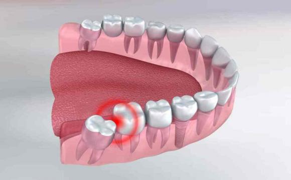 Điều gì xảy ra nếu răng khôn dài không được nhổ? Bác sĩ: 4 hiểm họa tiềm ẩn có thể ập đến, đừng bỏ qua