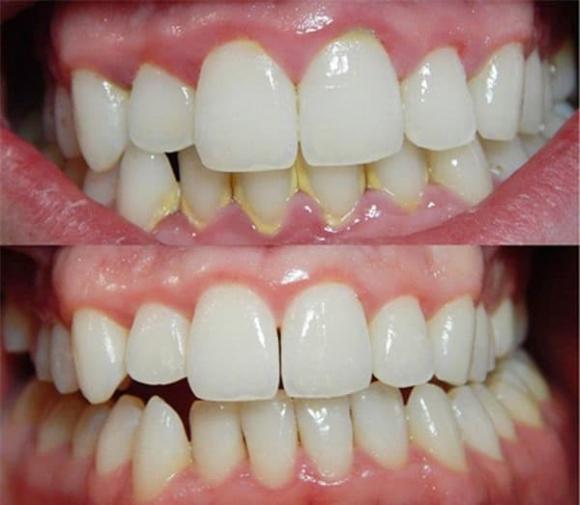 cao răng, sạch răng, vệ sinh răng miệng