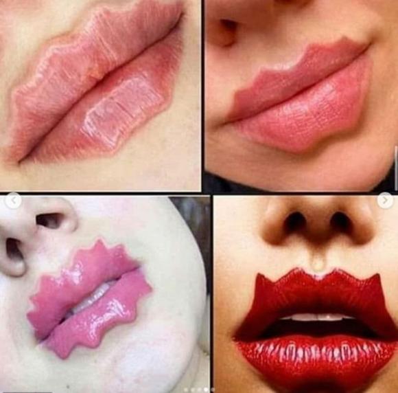 tiêm môi, các kiểu tiêm môi đẹp nhất, filler tạo dáng môi 