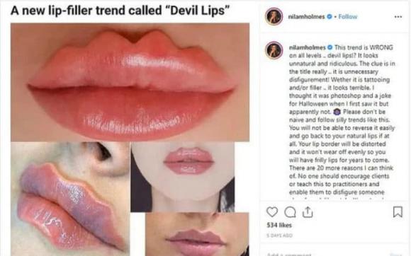tiêm môi, các kiểu tiêm môi đẹp nhất, filler tạo dáng môi 