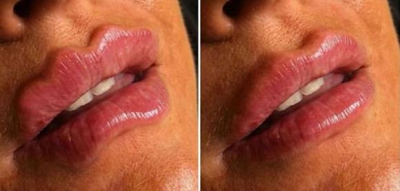 tiêm môi, các kiểu tiêm môi đẹp nhất, filler tạo dáng môi 