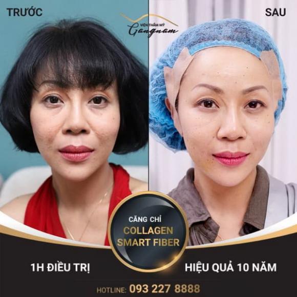 Trác Thúy Miêu, Viện thẩm mỹ Mega Gangnam, Trẻ hóa da