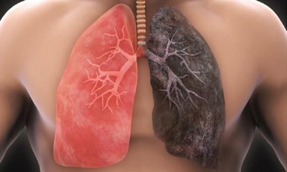 Ung thư phổi, dấu hiệu ung thư phổi