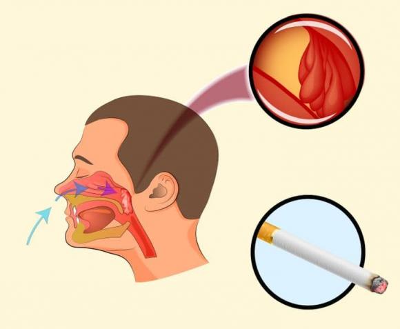 ngáy ngủ, cách chữa ngáy ngủ, phải làm sao khi bị ngáy ngủ