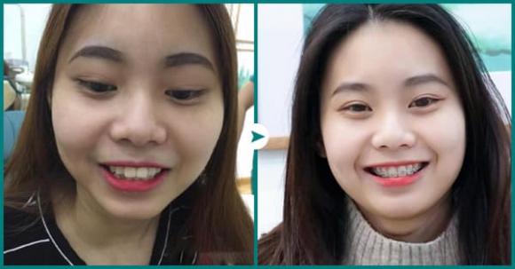 queen-smile-611-2-ngoisaovn-w600-h314 0 Niềng răng công nghệ mới, Nha khoa thẩm mỹ Queen Smile