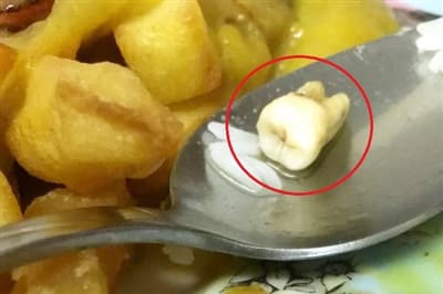 vật thể lạ trong đồ ăn, móng tay trong tô cháo, móng tay trong đồ ăn