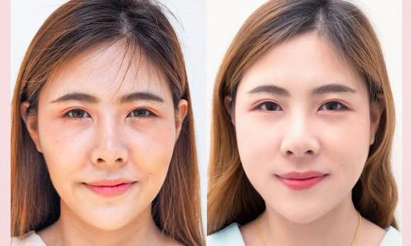 Phòng khám JK Việt Nam, Trị nám và tàn nhang, Pico Fusion