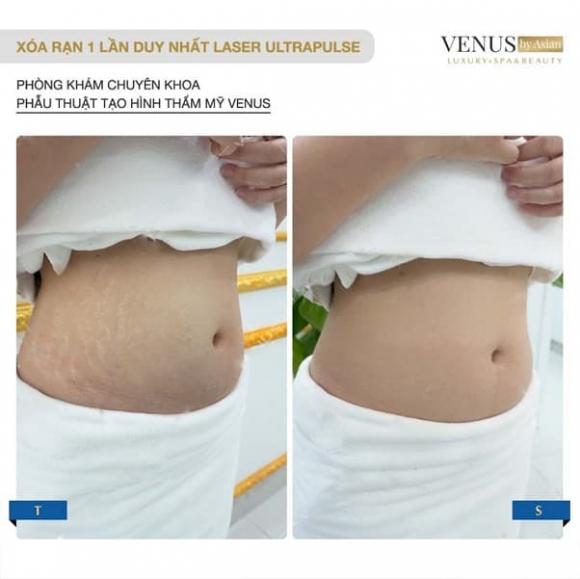tri-ran-da-2411-2-ngoisaovn-w602-h601 4 Trị rạn da, Phòng khám chuyên khoa Phẫu thuật tạo hình thẩm mỹ Venus, Venus by Asian
