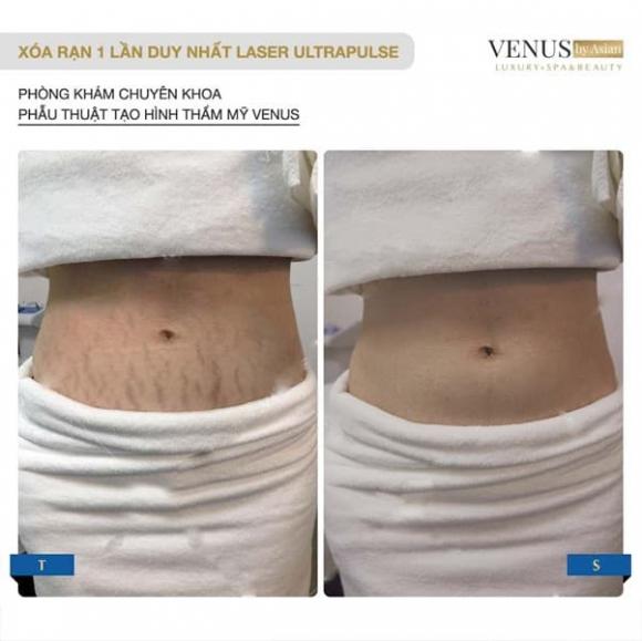 tri-ran-da-2411-4-ngoisaovn-w602-h601 2 Trị rạn da, Phòng khám chuyên khoa Phẫu thuật tạo hình thẩm mỹ Venus, Venus by Asian