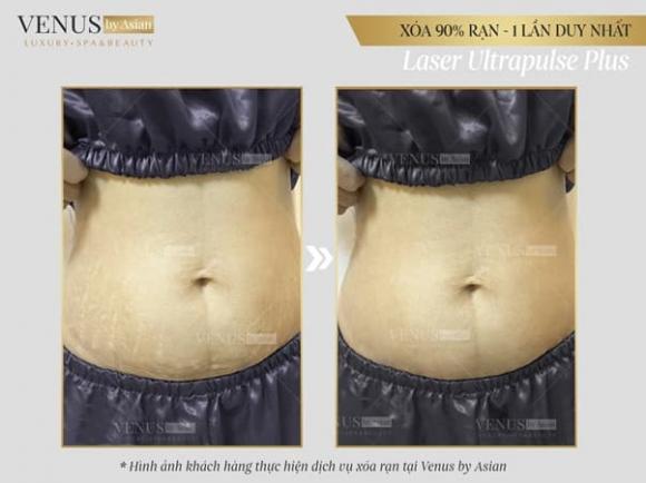 tri-ran-da-2411-6-ngoisaovn-w602-h451 0 Trị rạn da, Phòng khám chuyên khoa Phẫu thuật tạo hình thẩm mỹ Venus, Venus by Asian