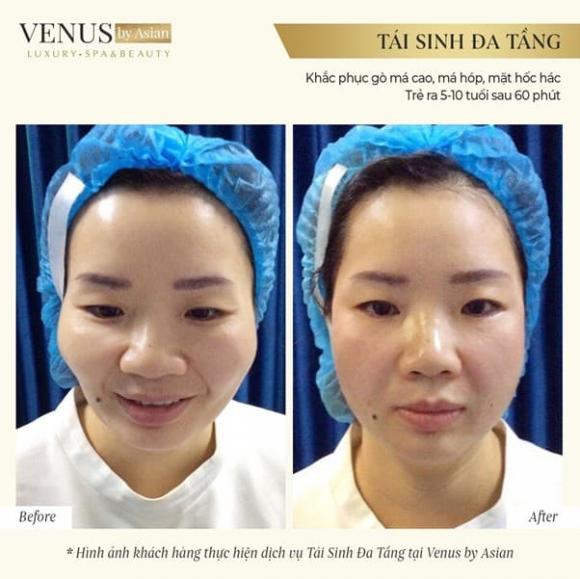 tai-sinh-da-tang-2511 (1).jpg 0 Tái sinh đa tầng, Phòng khám chuyên khoa Phẫu thuật tạo hình thẩm mỹ Venus, Venus by Asian