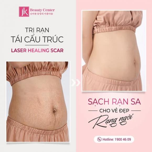 tri-ran-da-3011-1-ngoisaovn-w602-h601 3 Điều trị rạn da, trị rạn tái cấu trúc Healing Scar, Phòng khám chuyên khoa thẩm mỹ JK Việt Nam