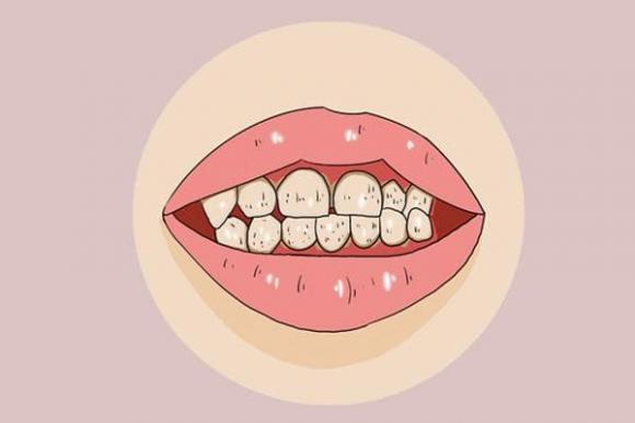 sức khoẻ răng miệng, vệ sinh răng, bùn vàng