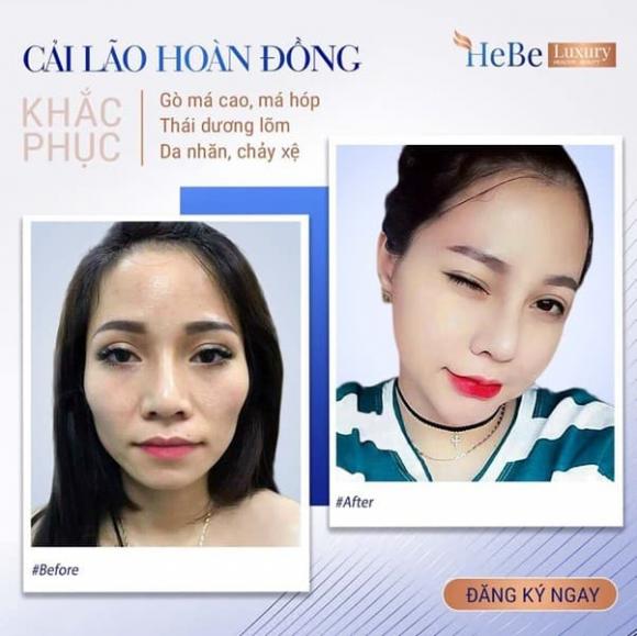 hebe-luxury-812 (1).jpg 1 Hebe Luxury, gò má cao, Thẩm mỹ viện Quốc tế Hebe Luxury