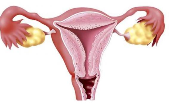 ung thư cổ tử cung, ung thư, sức khỏe phụ nữ
