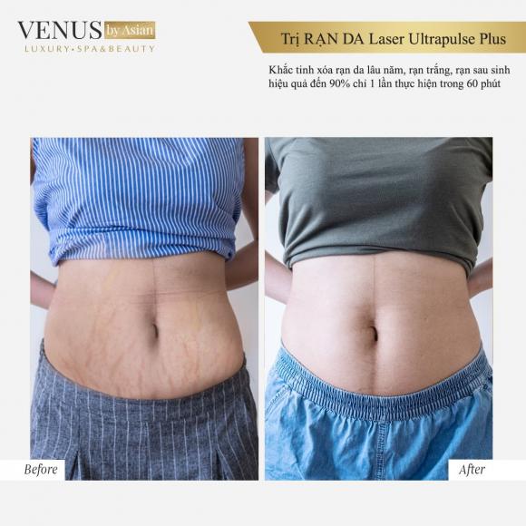 Trị rạn da, Phòng khám chuyên khoa phẫu thuật tạo hình thẩm mỹ Venus By Asian