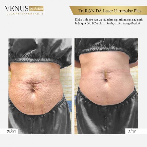 Trị rạn da, Phòng khám chuyên khoa phẫu thuật tạo hình thẩm mỹ Venus By Asian