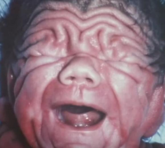 Bé Trai Sinh Ra Toàn Thân Nhăn Nheo Như Ông Già, Gây Chấn Động Y Học Thế  Giới Lớn Lên Nhìn Ra Sao?