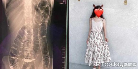 táo bón, không đi vệ sinh 17 ngày, u trực tràng