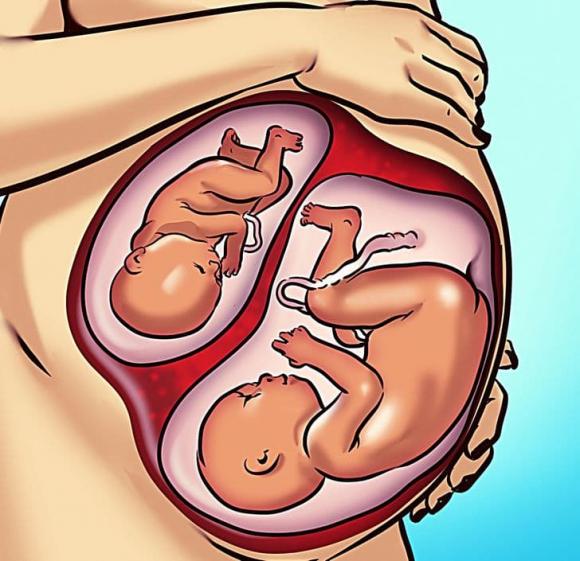 siêu thai, mang thai khi đang mang bầu, sức khỏe 
