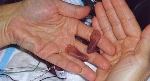 Interesting story, the world's smallest baby girl, born only 25 cm