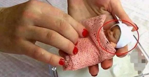 Interesting story, the world's smallest baby girl, born only 25 cm