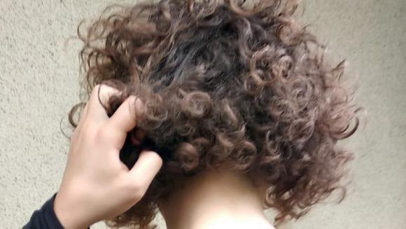hội chứng nhổ tóc, hội chứng ăn tóc, trẻ tắc ruột vì ăn tóc