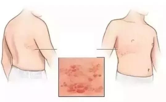 Bệnh zona thần kinh, chăm sóc sức khỏe đúng cách, lưu ý khi chăm sóc sức khỏe