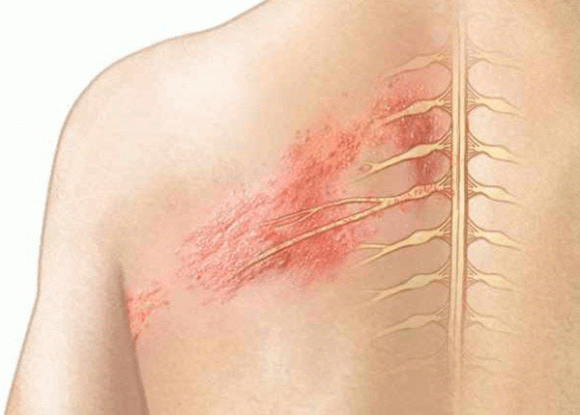 Bệnh zona thần kinh, chăm sóc sức khỏe đúng cách, lưu ý khi chăm sóc sức khỏe