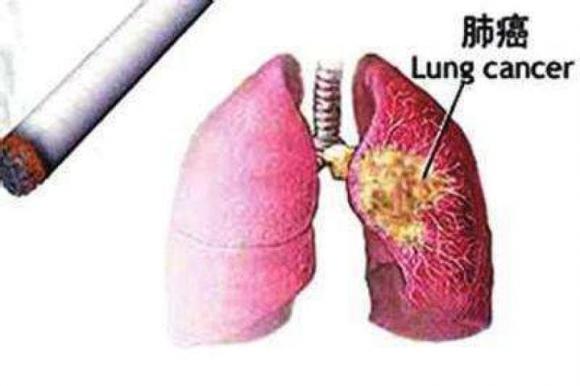 Ung thư phổi, triệu chứng ung thư phổi