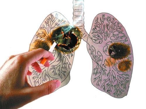 Ung thư phổi, triệu chứng ung thư phổi