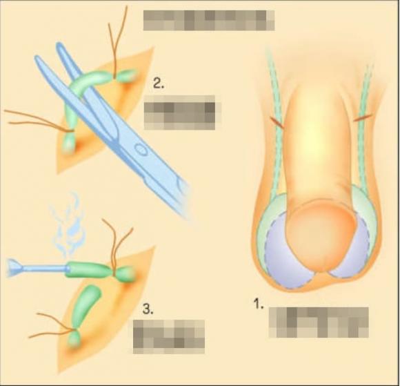  ống dẫn tinh, thắt  ống dẫn tinh, kế hoạch
