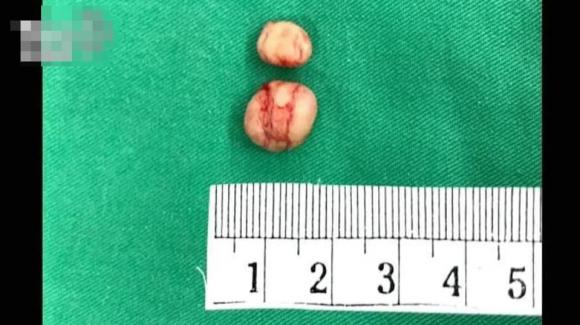 xỏ khuyên tai, xỏ lỗ tai, tai nạn làm đẹp, thẩm mỹ lỗi