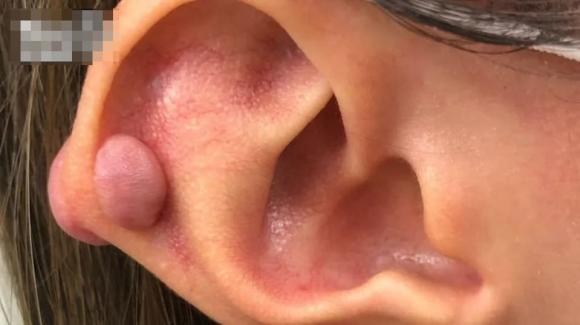 xỏ khuyên tai, xỏ lỗ tai, tai nạn làm đẹp, thẩm mỹ lỗi