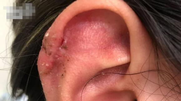 xỏ khuyên tai, xỏ lỗ tai, tai nạn làm đẹp, thẩm mỹ lỗi