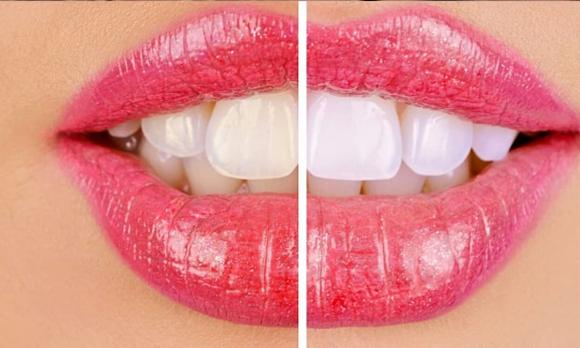 làm trắng răng, lưu ý khi làm trắng răng, Làm trắng răng có gây hại cho răng của bạn không