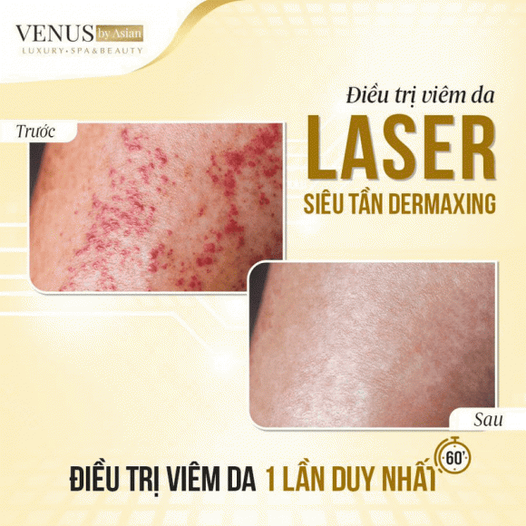 dieu-tri-viem-da-1311 (1).png 0 Venus by Asian, viêm da, điều trị viêm da, Phòng khám Thẩm mỹ Venus by Aisan