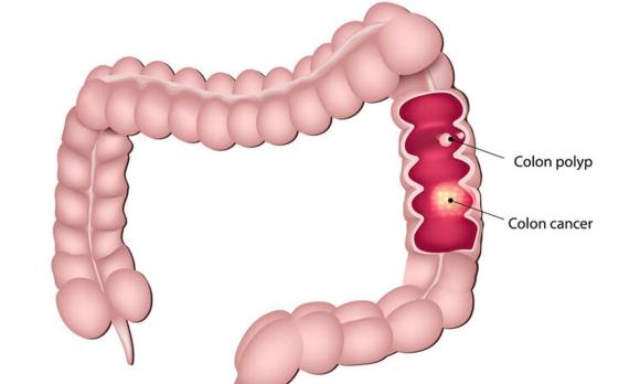 chăm sóc sức khỏe đúng cách, lưu ý khi chăm sóc sức khỏe, ung thư gan