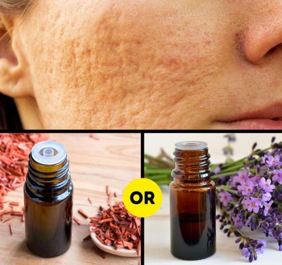 chữa sẹo, mẹo chữa sẹo, cách giúp lành da 