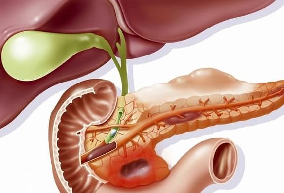 Ung thư tuyến tụy, sức khỏe