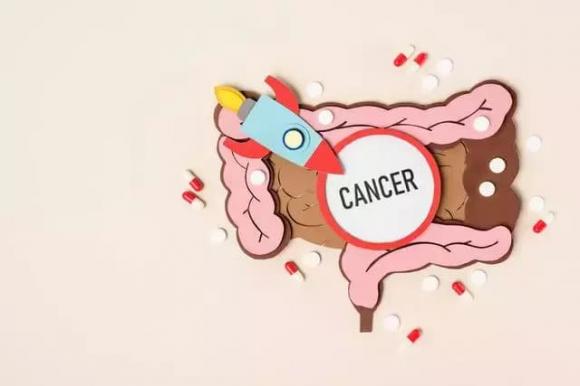 ung thư ruột, ung thư, triệu trứng ung thư ruột