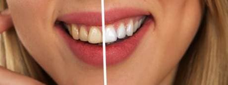 cao răng, mẹo hoặc, làm sạch sẽ cao răng
