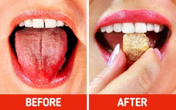 bỏng lưỡi, bỏng rát lưỡi, chữa lành vết bỏng rát lưỡi,