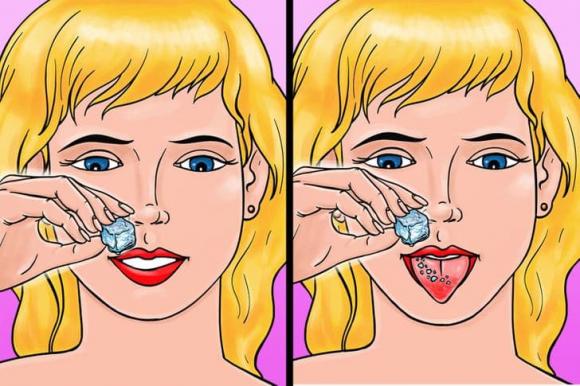 bỏng lưỡi, bỏng rát lưỡi, chữa lành vết bỏng rát lưỡi,