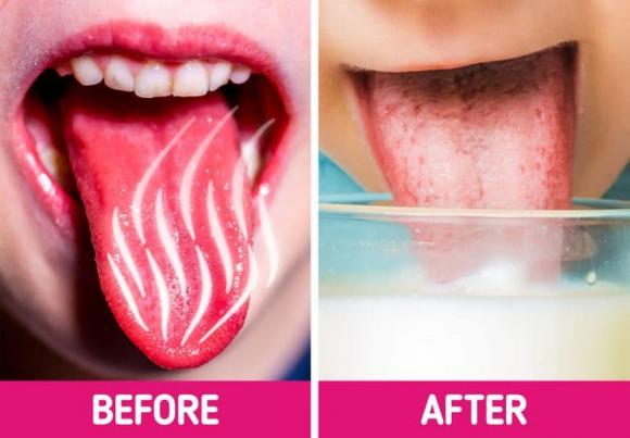 bỏng lưỡi, bỏng rát lưỡi, chữa lành vết bỏng rát lưỡi,